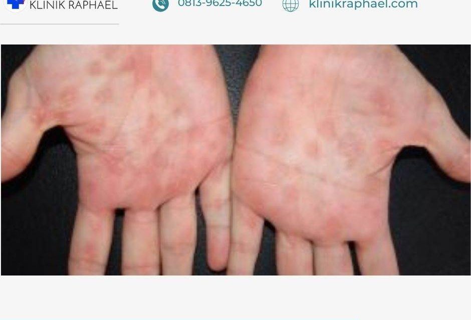Bahaya Eksim Yang Sering Dianggap Sepele