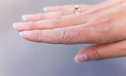 Bahaya Psoriasis Jika Tidak Ditangani Dengan Tepat