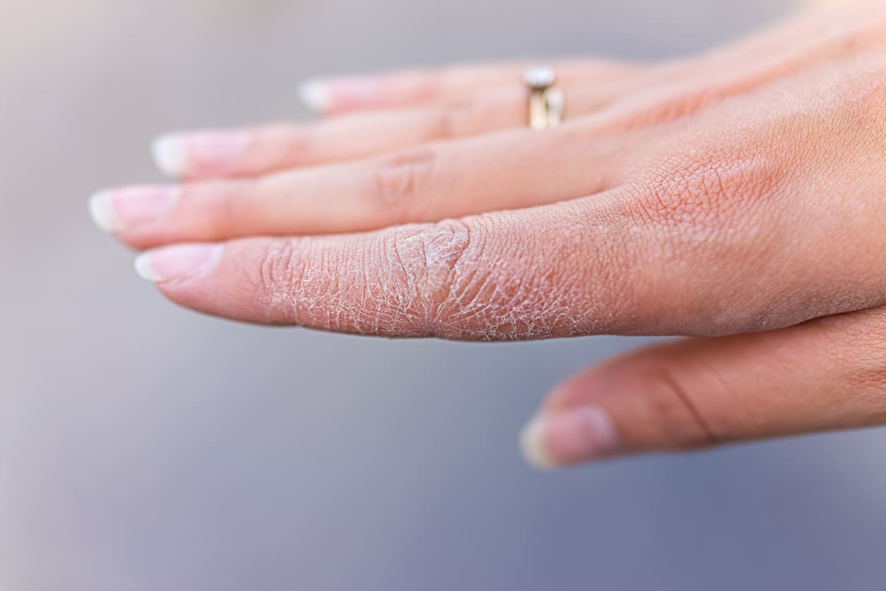 Bahaya Psoriasis Jika Tidak Ditangani Dengan Tepat